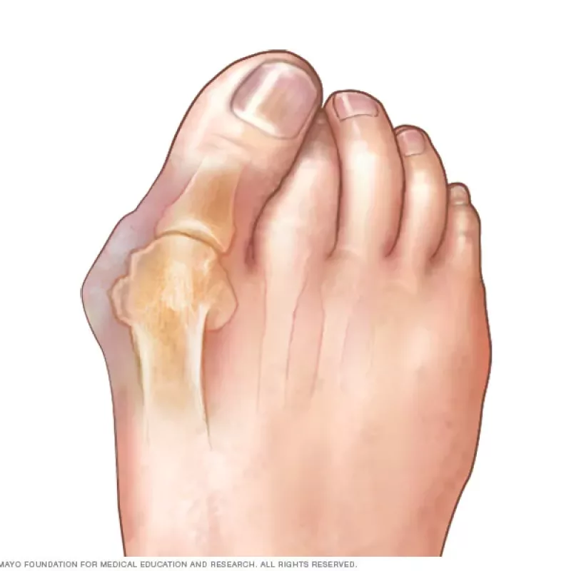 mcdc7_bunion-8col mcdc7_bunion-8col