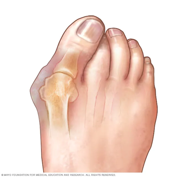 mcdc7_bunion-8col mcdc7_bunion-8col